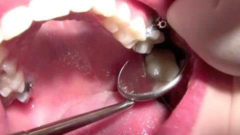 Fitting Maxillary and Mandibular Molar Bands