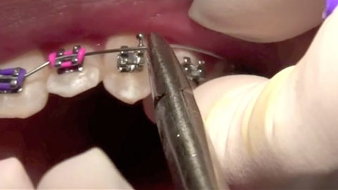 Initial Bonding of Brackets and Placement of Initial Archwires